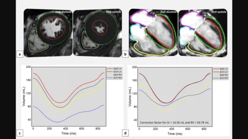 Researchers have developed and validated a new artificial intelligence (AI) model capable of producing four-chamber cardiac MR (CMR) images in seconds, publishing their findings in European Radiology Experimental.
