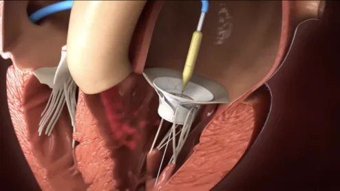 Innovalve Bio Medical's Innostay TMVR device. Edwards Lifesciences has agreed to acquire Innovalve after an initial investment in 2017.