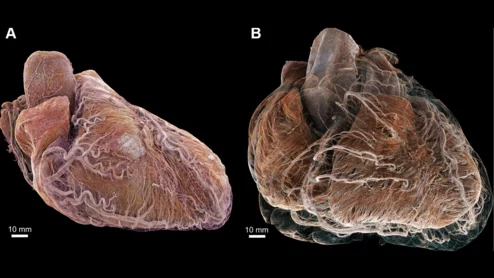 Researchers with University College London and the European Synchrotron Radiation Facility (ESRF) have used a new X-ray technique, hierarchical phase-contrast tomography (HiP-CT), to capture images of the human heart in unprecedented detail. The group shared its images, as well as a full analysis, in Radiology.[1]