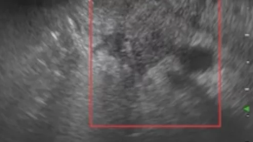 AI helps identify malignant/benign pancreatic lesions