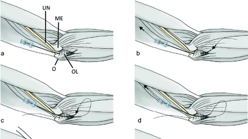 New IR procedure for cubital tunnel syndrome