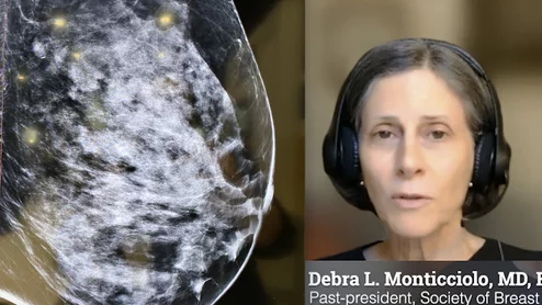 Debra L. Monticciolo, MD, FACR, FSBI, past-president of both the Society of Breast Imaging (SBI), and the American College of Radiology (ACR), explains the current recommendations and a study she did looking at real patient data and projected outcomes using different screening parameters.