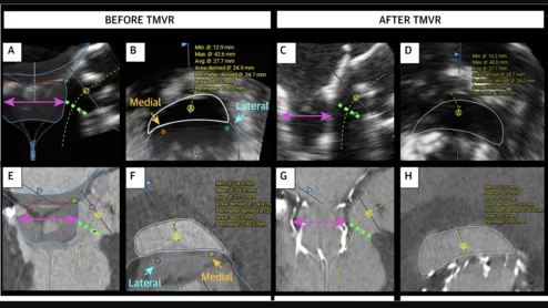 Echocardiography vs CT for Prediction of Newly Created LVOT Area during TMVR