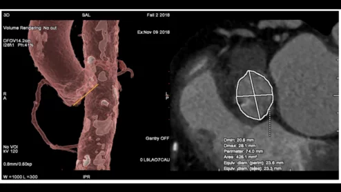 TAVR planning with GE Healthcare's Valve Assist 2 technology