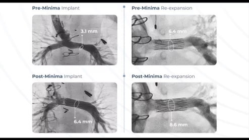Renata Medical, a California-based healthcare technology company, has gained U.S. Food and Drug Administration (FDA) approval for a new stent specifically designed for pediatric patients with congenital heart defects. The Minima Growth Stent was built to treat newborns, infants and young children, and then it continues to expand as the patient ages