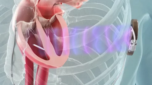 The MODULAR ATP study demonstrated a high rate of successful leadless pacemaker implantation with few complications and stable pacing parameters. The system uses the Emblem Subcutaneous Implantable Defibrillator (S-ICD) System and the new Empower Leadless Pacemaker from Boston Scientific.