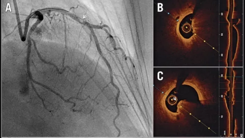 OCT-guided PCI, or optical coherence tomography-guided percutaneous coronary intervention. 