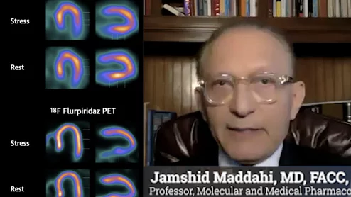 AURORA trial results for Flurpiridaz F-18 PET vs. SPECT discussed by principal investigator Jamshid Maddahi, MD.