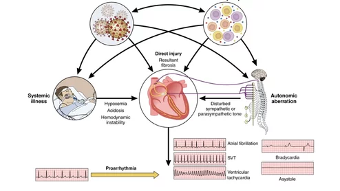 Overview of the pathophysiological mechanisms associated with arrhythmogenesis in the setting of COVID-19 infection. Image from Circulation.