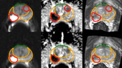 AI prostate lesion segmentation algorithm