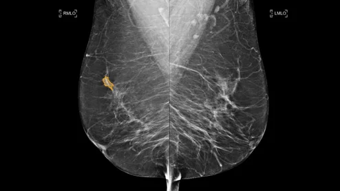 MedCognetics CogNet AI-MT technology is the first embedded AI cancer detection system built into the mammography system to eliminate eliminates latency and delivering immediate, high-quality image analysis and can help prioritize exams in the worklist