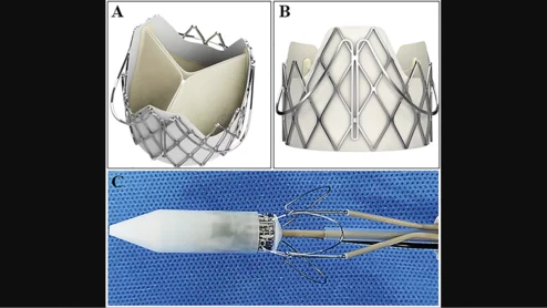 Performing transcatheter aortic valve replacement (TAVR) with the J-Valve transcatheter heart valve (THV) may help limit the risk of coronary artery obstruction (CAO) in high-risk patients, according to a new study published in Clinical Interventions in Aging.[1]