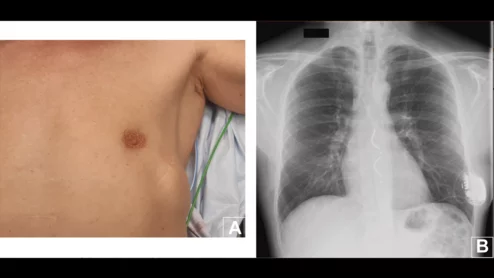 Cardiologists have performed what they believe to be the world’s first substernal lead extraction, sharing their experience in JACC: Case Reports.[1]The device being extracted, Medtronic’s Aurora EV-ICD, received U.S. Food and Drug Administration (FDA) approval in October 2023.