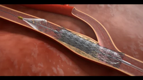 Contego Medical, a North Carolina-based medical device company, has received U.S. Food and Drug Administration (FDA) approval for its new all-in-one carotid stenting offering, the Neuroguard IEP System