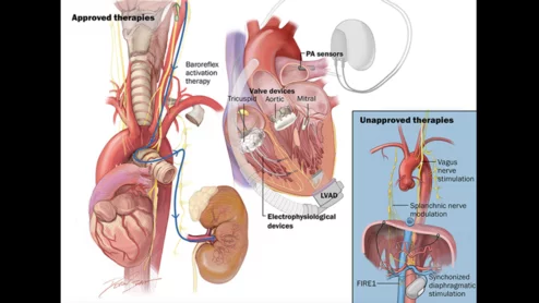 Advanced device-based therapies are associated with significant benefits for heart failure patients and should be used alongside traditional pharmaceutical treatments, according to a new scientific statement from the Heart Failure Society of America (HFSA). The statement, published in full in the Journal of Cardiac Failure, examines a number of new-look medical devices that have emerged in recent years as additional ways to treat heart failure.