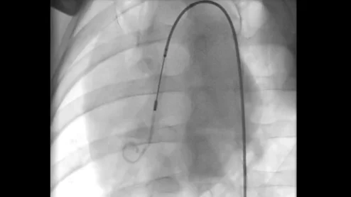 Impella ECP heart pump insertion Abiomed Johnson & Johnson MedTech