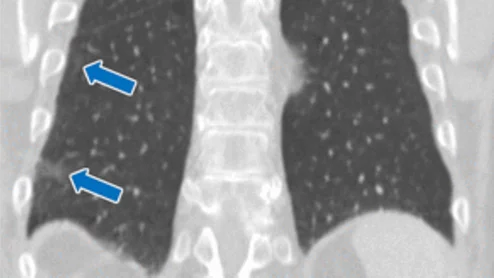 Incidental interstitial lung abnormalities largely underreported