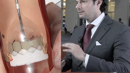 Philippe Genereux explains how EARLY TAVR will help raise awareness for undertreatment of TAVR.