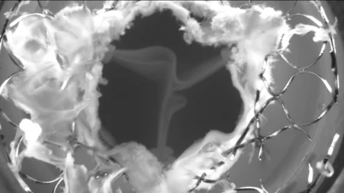 Redo TAVR: A 26-mm Sapien 3 device (Edwards Lifesciences) implanted within a 29-mm CoreValve device (Medtronic). Image courtesy of EuroIntervention. 