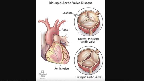 bicuspid aortic valve disease TAVR 