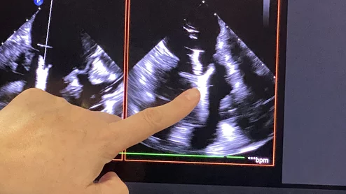 Abbott TriClip tricuspid edge-to-edge repair (T-TEER) device shown on transesophageal echo (TEE). The device clips together the leaflets of the valve to form a better seal and reduce regurgitation without the need for open heart surgery. Photo by Dave Fornell