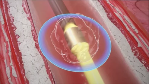 The use of intravascular lithotripsy (IVL) during percutaneous coronary intervention (PCI) is still safe and effective when patients present with calcified nodules (CNs), according to new long-term data published in EuroIntervention.[1] Researchers compared outcomes from patients with and without CNs, highlighting key similarities in stent expansion and luminal gain.