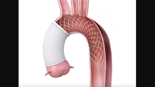 Artivion, an Atlanta-based medical device company, has received a Humanitarian Device Exemption (HDE) from the U.S. Food and Drug Administration (FDA) for its AMDS Hybrid Prosthesis designed to treat DeBakey Type 1 dissections when malperfusion occurs. This HDE ensures select patients can be treated with the device before the FDA makes its final approval decision.