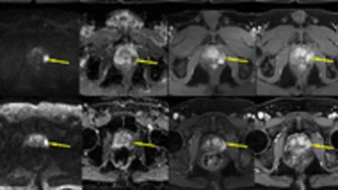 Simulated MR images could eliminate the need for contrast in prostate scans.