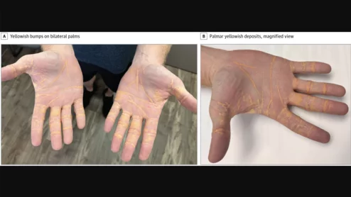 Following a high-fat diet impacted one middle-aged man’s cardiovascular health so much that cholesterol appeared to start leaking out of his hands. 