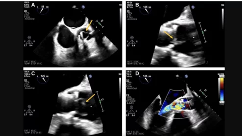 Cardiologists in Spain encountered an unexpected complication in a 78-year-old transcatheter aortic valve replacement (TAVR) patient, highlighting the experience in JACC: Cardiovascular Interventions.