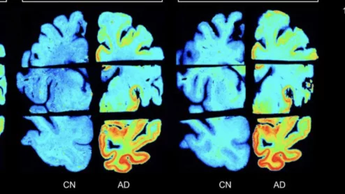 New radiotracers outperform FDA-approved agent for detection of tau tangles.