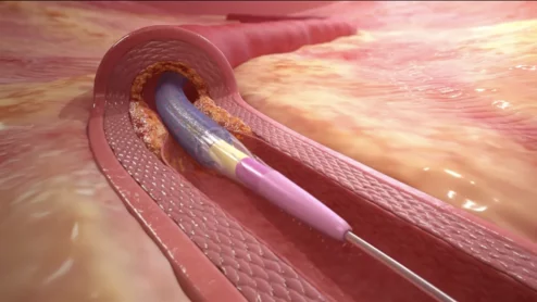 Prevail DCB Medtronic