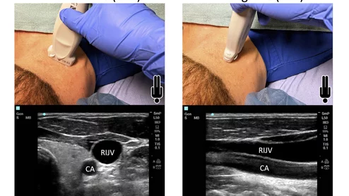 Figure from the new ASE guideline for ultrasound guided vascular access, showing vessel and probe orientation on the transverse plane short axis (SAX) view perpendicular to the vessels, or in longitudinal long axis plane (LAX) coaxial to the vessels. Image courtesy of ASE