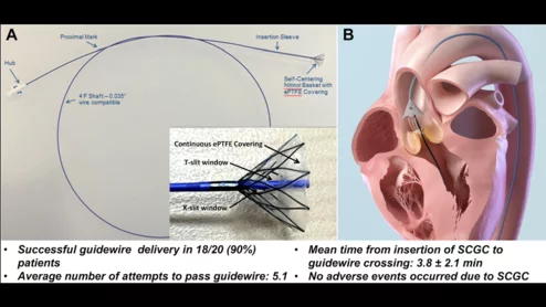 self-centering guide catheter (SCGC) for TAVR from Boston Scientific 