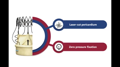 Corcym has received U.S. Food and Drug Administration (FDA) approval for a new version of its Perceval Plus surgical aortic heart valve that includes the company’s advanced LANCELOT features. 