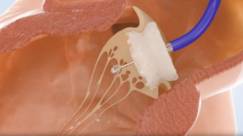 Capstan Medical robotic transcatheter mitral valve replacement