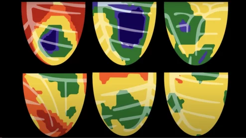 HeartSee 4.0 Bracco Diagnostics