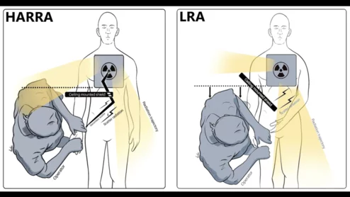 Using a left radial artery (LRA) vs. hyper-adducted right radial artery (HARRA) approach in the cath lab