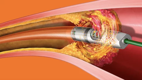 Bard Peripheral Vascular Rotarex Atherectomy System recall