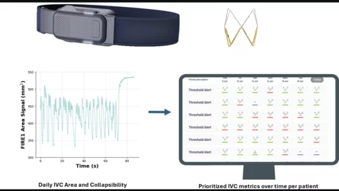 FIRE1 Norm inferior vena cava (IVC) heart failure sensor