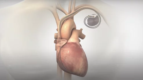 Orchestra BioMed Holdings AVIM Therapy FDA breakthrough device