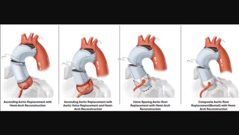 Society of Thoracic Surgeons shares new risk calculator for aortic surgeries