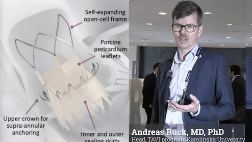 Video interview with Andreas Ruck, MD, explaining a SWEDHEART registry comparison of Acurate Neo2 to Sapien and Evolut TAVR valves.