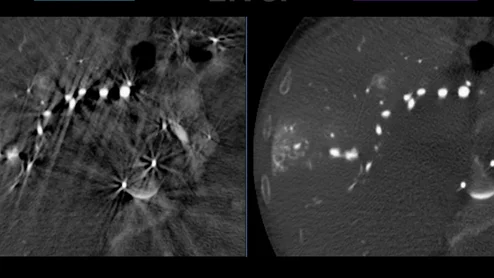 GE Healthcare's CleaRecon DL reduces IR image artifacts during procedures