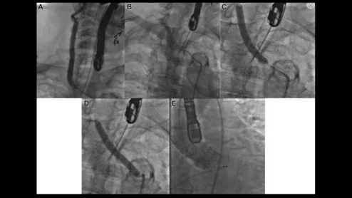 Intravascular lithotripsy IVL carotid artery TAVR