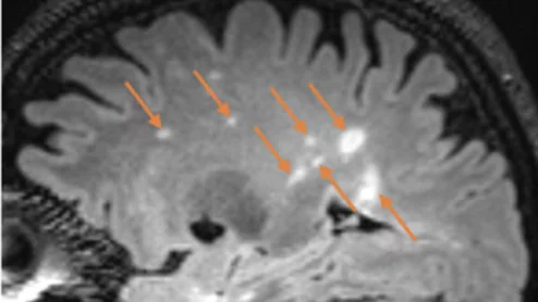6-minute MRI can diagnose multiple sclerosis