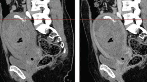CT identifies postpartum hemorrhage resistant to treatment