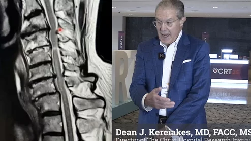 Dean Kereiakes, a nationally renowned interventional cardiologist and president of The Christ Hospital Heart and Vascular Institute, has long been recognized for his groundbreaking work in cardiovascular research and intervention. But in 2024, his career and his life were permanently altered when decades of wearing heavy lead protection in the cath lab left him paralyzed.