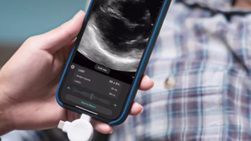 Exo Iris AI inks another FDA clearance for pleural effusion