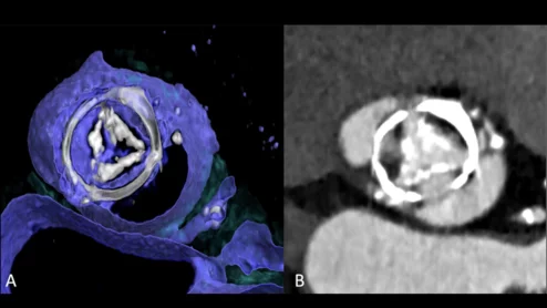 CT imaging showing structural valve deterioration 